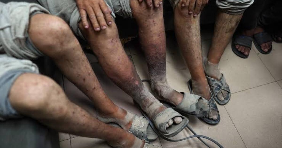 وزارة الأسرى بغزة تحذّر من انتشار الجرب بين الأسيرات في سجن الدامون